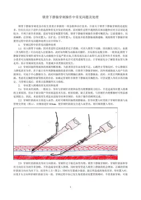 锁骨下静脉穿刺常见问题及处理