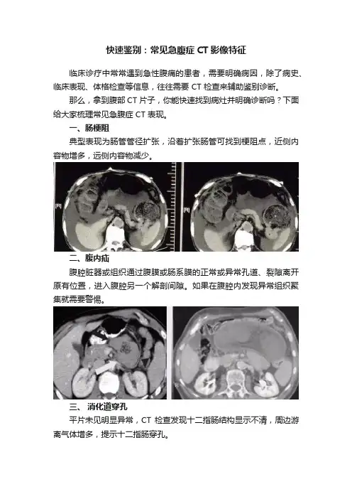 快速鉴别：常见急腹症CT影像特征
