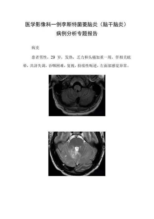 医学影像科李斯特菌菱脑炎(脑干脑炎)病例分析专题报告