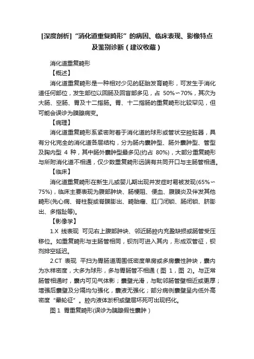 [深度剖析]“消化道重复畸形”的病因、临床表现、影像特点及鉴别诊断（建议收藏）