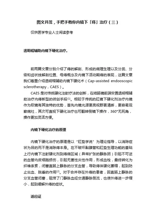 ?图文并茂，手把手教你内镜下「痔」治疗（三）