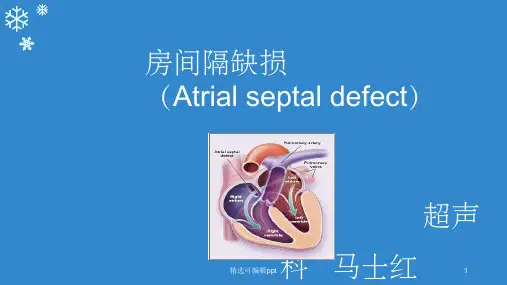 房间隔缺损PPT