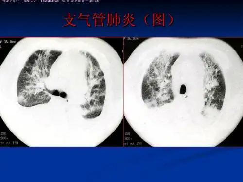 医学影像诊断学-呼吸系统4