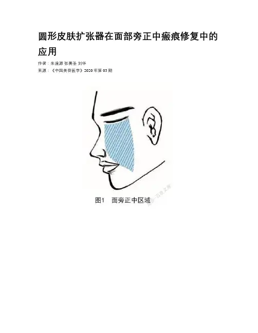 圆形皮肤扩张器在面部旁正中瘢痕修复中的应用