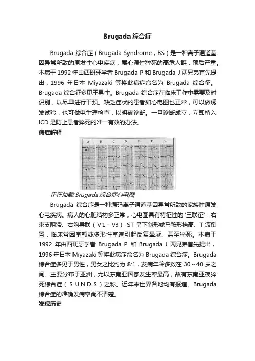 Brugada综合症