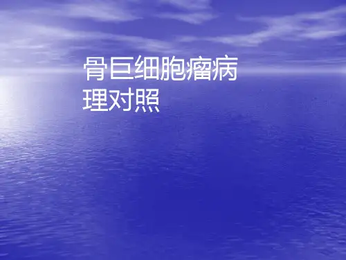 骨巨细胞瘤ppt课件