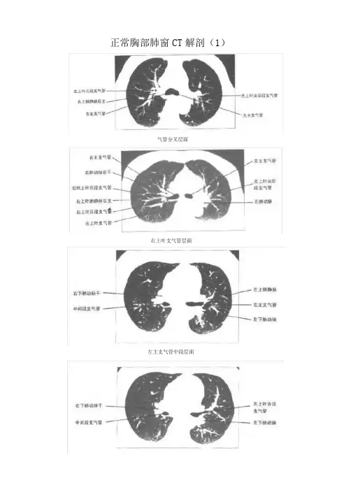 正常胸部CT解剖(肺窗和纵隔窗)