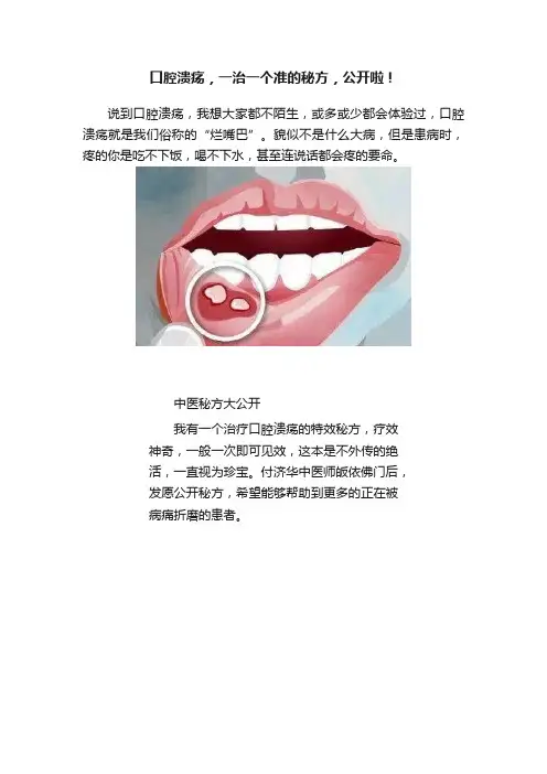 口腔溃疡，一治一个准的秘方，公开啦！