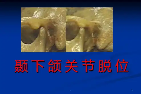颞下颌关节脱位PPT课件