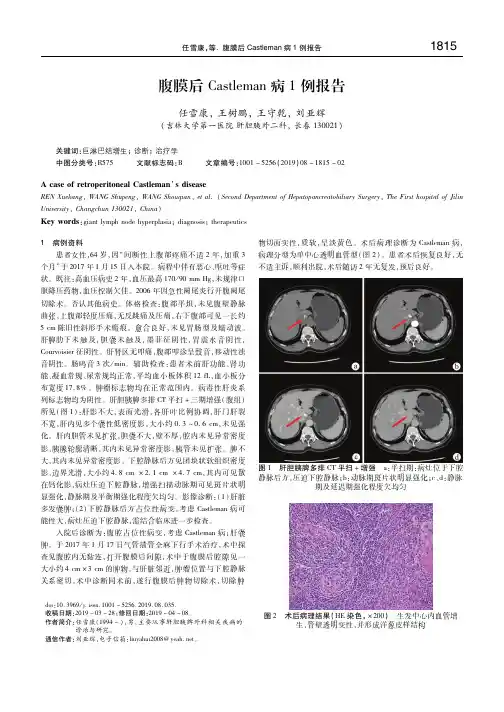 腹膜后Castleman病1例报告 任雪康