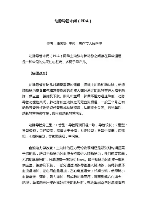 动脉导管未闭（PDA）