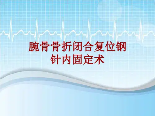 手术讲解模板：腕骨骨折闭合复位钢针内固定术