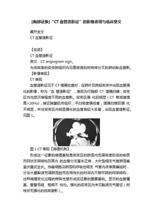 [胸部征象]“CT血管造影征”的影像表现与临床意义