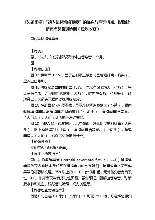 [头颈影像]“颈内动脉海绵窦瘘”的临床与病理特点、影像诊断要点及鉴别诊断（建议收藏）~~~