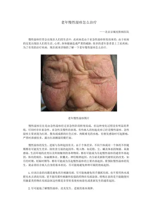 老年慢性湿疹怎么治疗