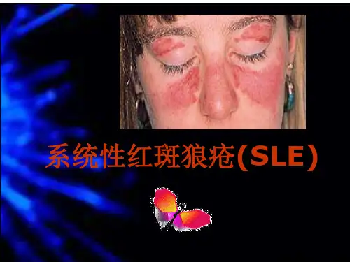 系统性红斑狼疮
