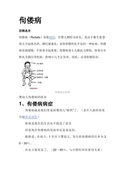 佝偻病