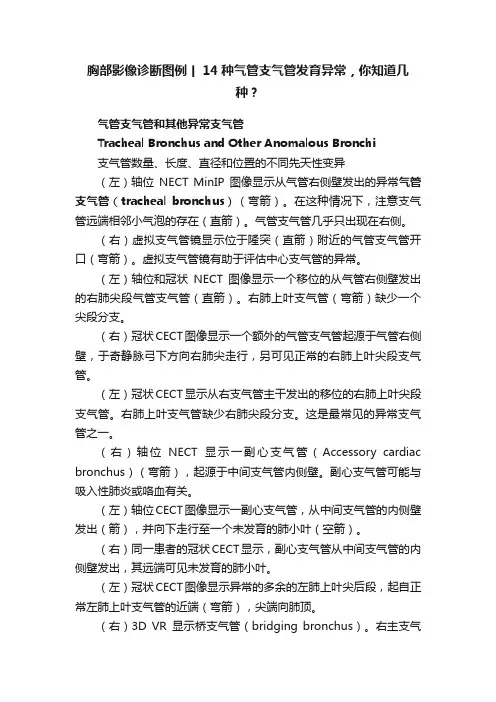 胸部影像诊断图例丨14种气管支气管发育异常，你知道几种？