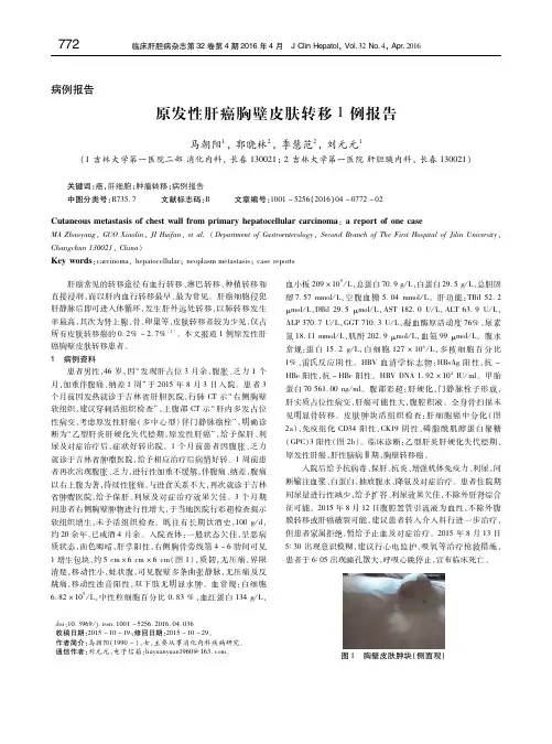 原发性肝癌胸壁皮肤转移1例报告 马朝阳