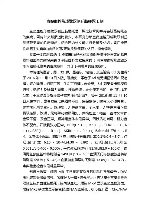 直窦血栓形成致双侧丘脑梗死1例