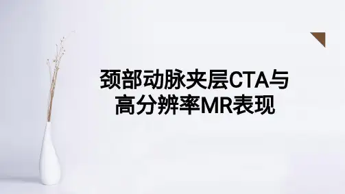 颈部动脉夹层
