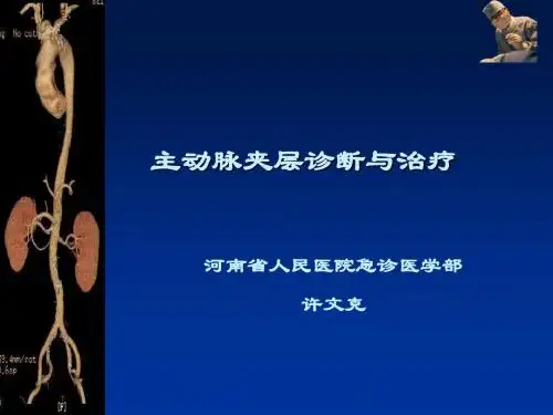主动脉夹层诊断与治疗