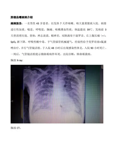 肺曲霉菌