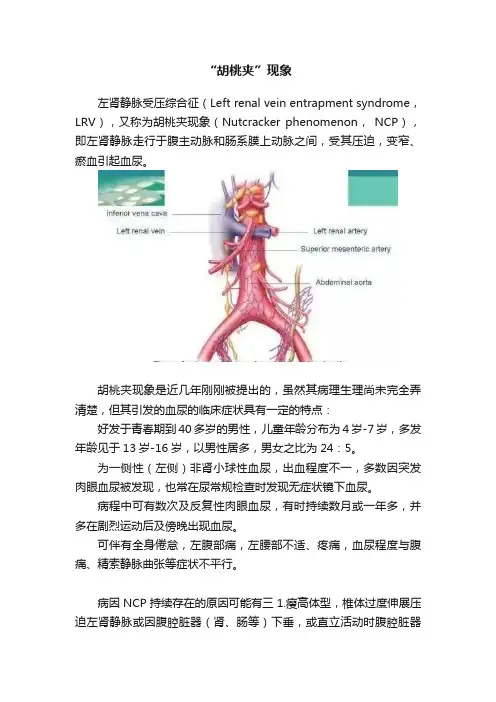 “胡桃夹”现象