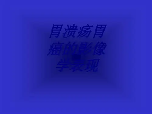 胃溃疡胃癌的影像学表现PPT医学课件