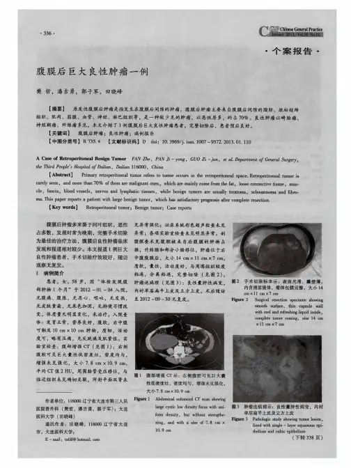 腹膜后巨大良性肿瘤一例