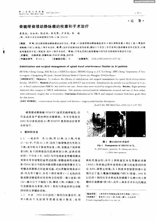 脊髓硬脊膜动静脉瘘的栓塞和手术治疗