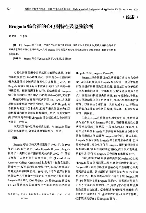 Brugada综合征的心电图特征及鉴别诊断