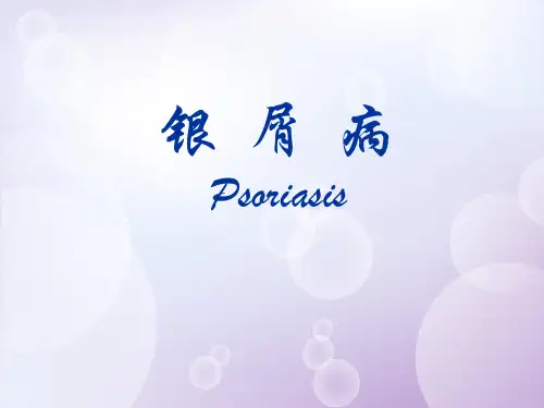 银屑病
