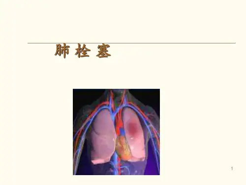 肺栓塞影像表现 ppt课件