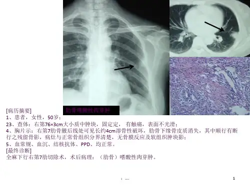 少见病例：肋骨嗜酸性肉芽肿ppt课件