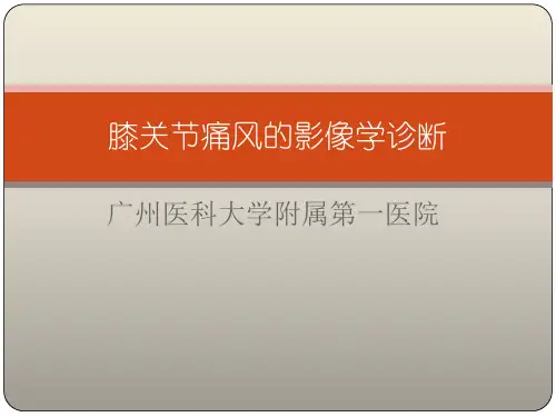 膝关节痛风的影像学诊断参考PPT