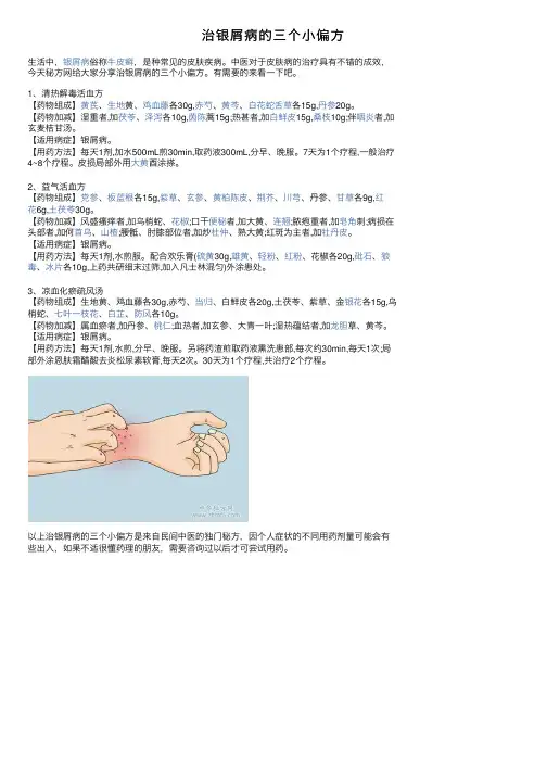 治银屑病的三个小偏方