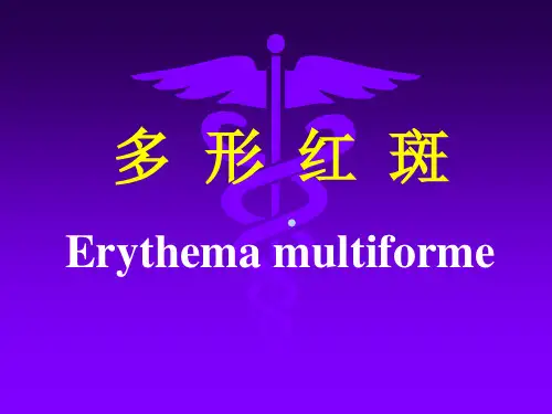 (PPT)多形红斑Erythemamultiforme