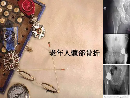 老年人髋部骨折课件