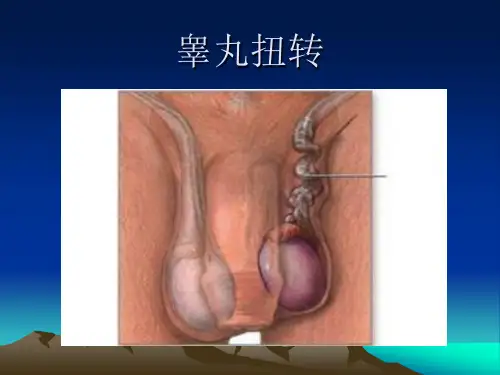 睾丸扭转