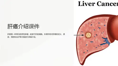 肝癌介绍课件