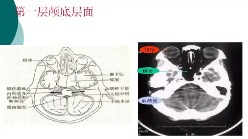 颅脑基本病变的CT诊断