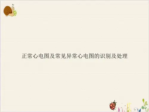正常心电图及常见异常心电图的识别及处理PPT.