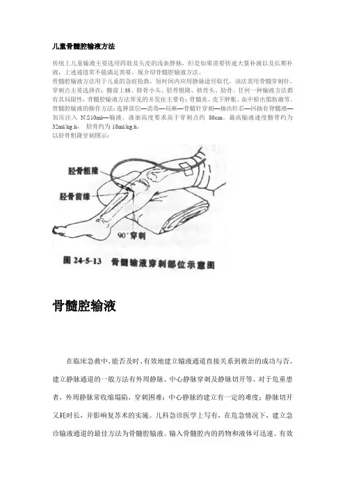 儿童骨髓腔输液方法