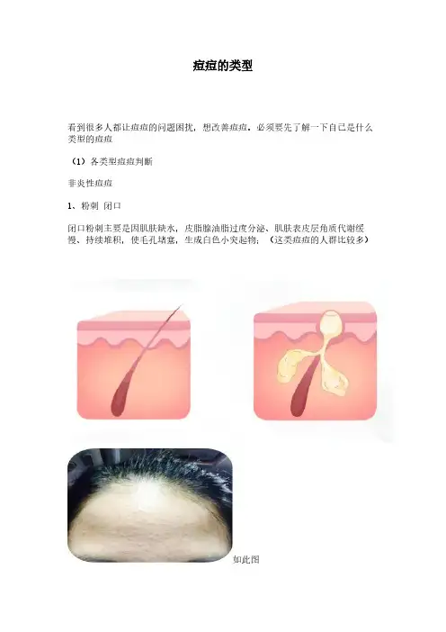 痘痘的类型