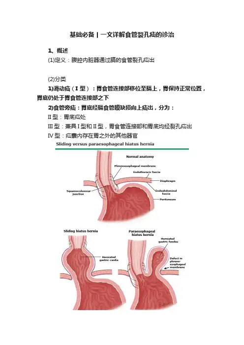 基础必备丨一文详解食管裂孔疝的诊治