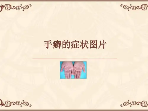 手癣的症状图片