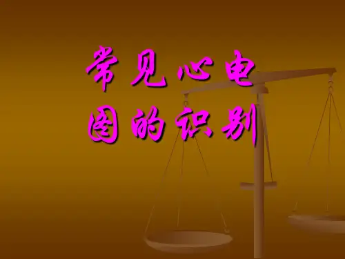 常见心电图的识别_课件