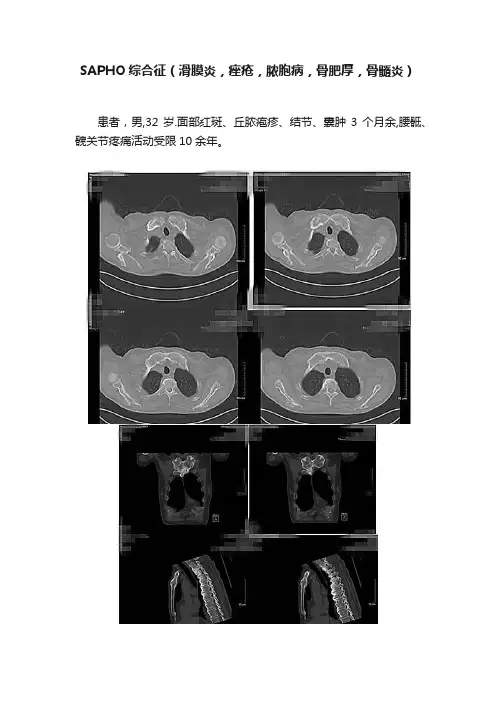 SAPHO综合征（滑膜炎，痤疮，脓胞病，骨肥厚，骨髓炎）