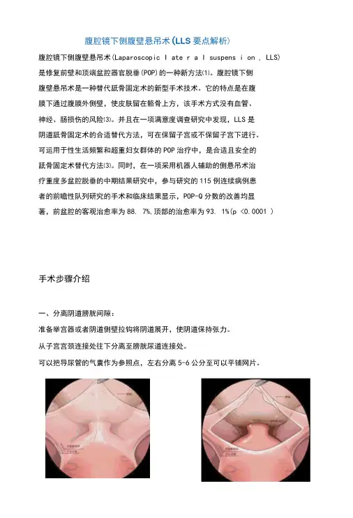 腹腔镜下侧腹壁悬吊术(LLS要点解析)